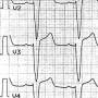 ekg-beispiel12b.jpg